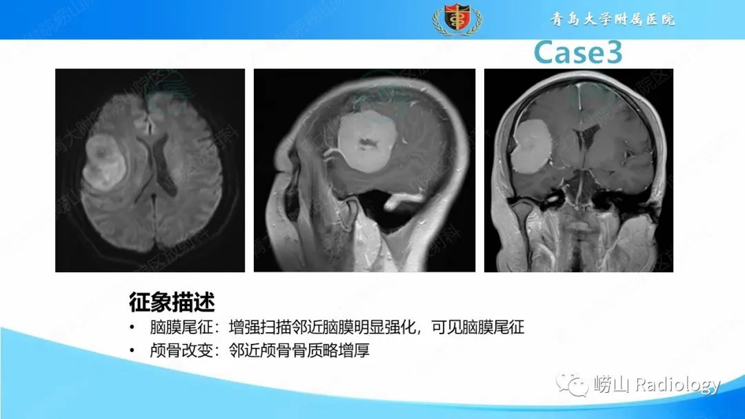 影像PPT - 【PPT】颅内肿瘤性病变-26