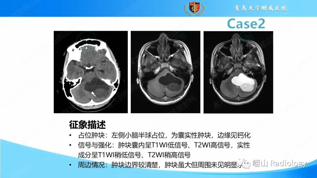 影像PPT - 【PPT】颅内肿瘤性病变-20