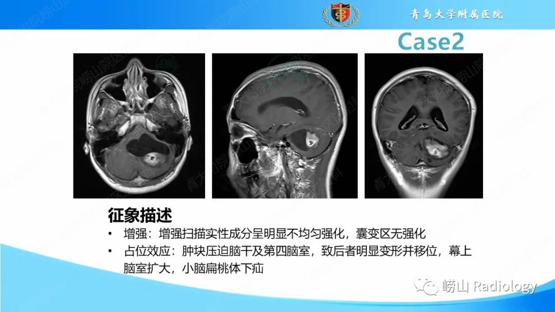 影像PPT - 【PPT】颅内肿瘤性病变-21