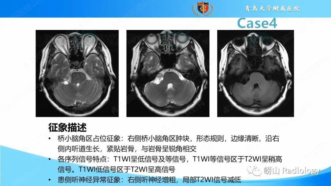 影像PPT - 【PPT】颅内肿瘤性病变-30