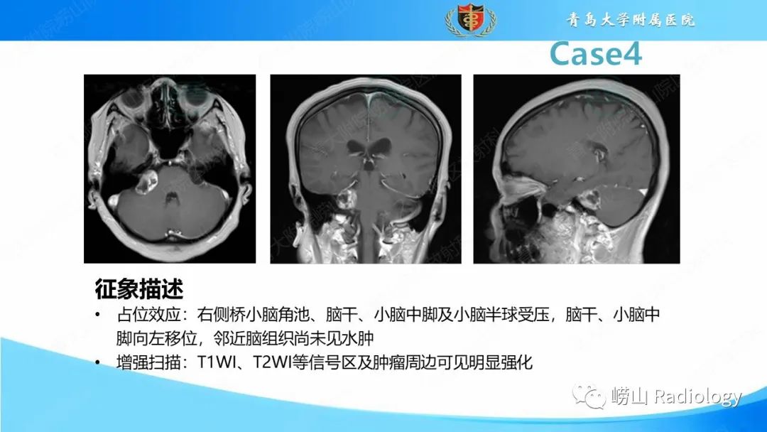 影像PPT - 【PPT】颅内肿瘤性病变-31