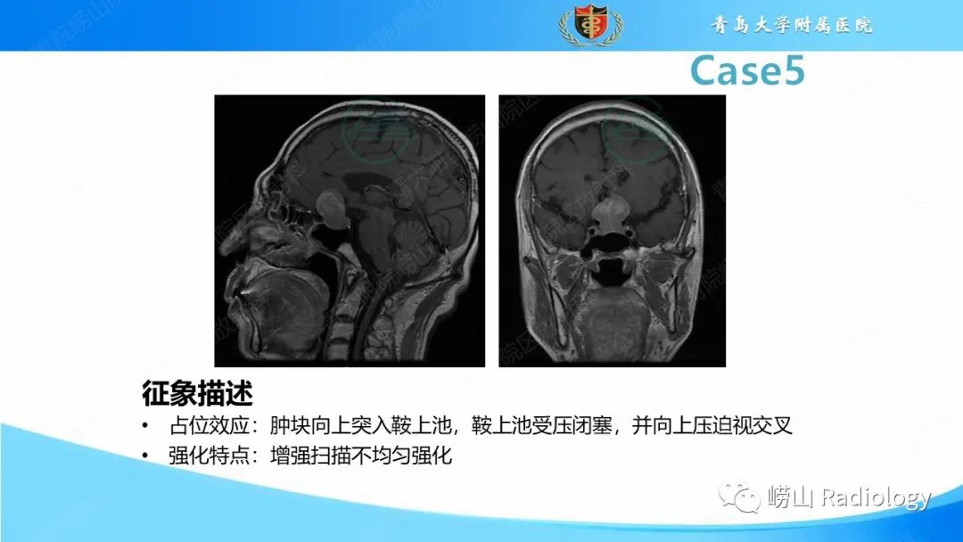 影像PPT - 【PPT】颅内肿瘤性病变-36