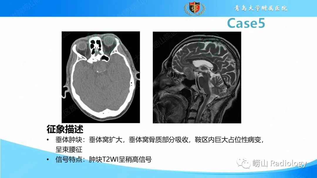 影像PPT - 【PPT】颅内肿瘤性病变-35