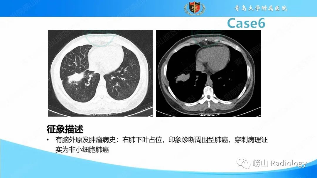 影像PPT - 【PPT】颅内肿瘤性病变-40
