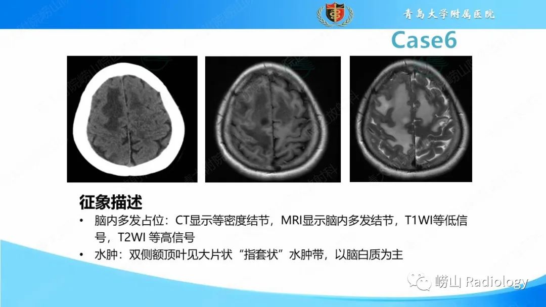影像PPT - 【PPT】颅内肿瘤性病变-41