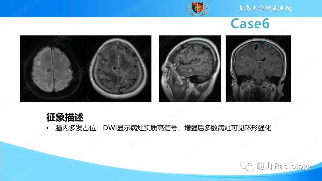 影像PPT - 【PPT】颅内肿瘤性病变-42