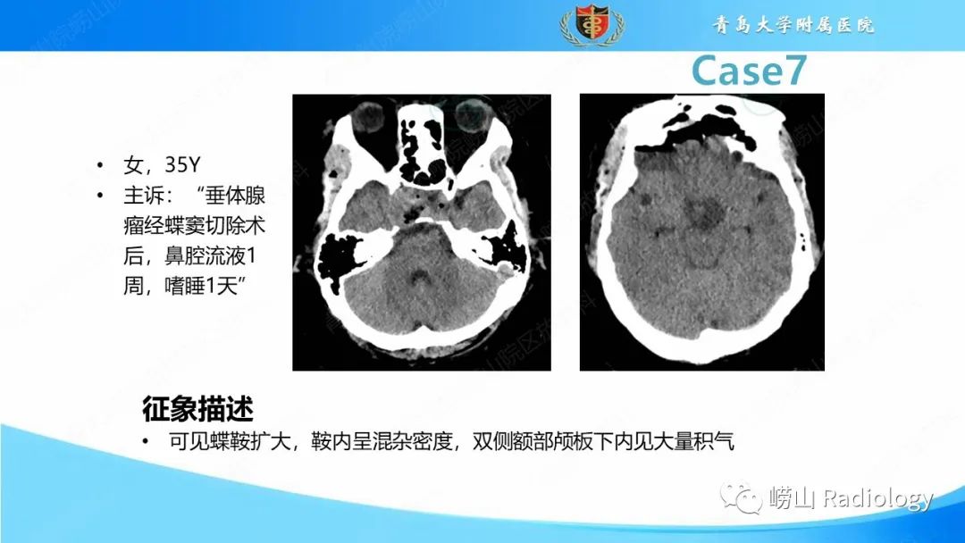 影像PPT - 【PPT】颅内肿瘤性病变-50