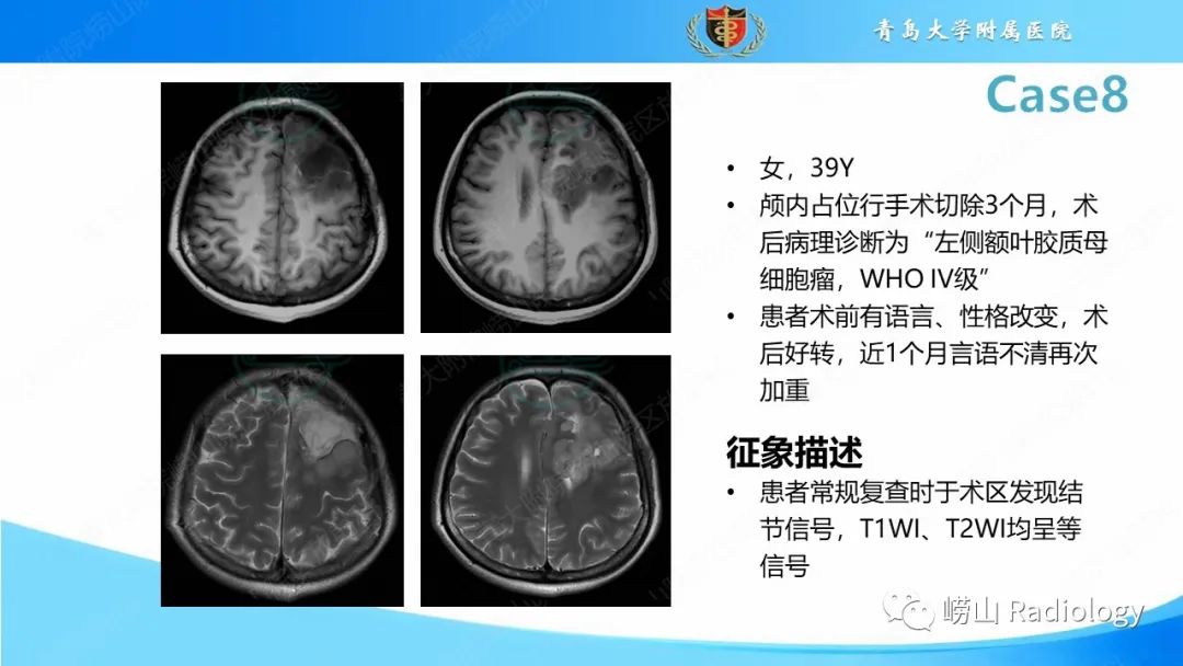 影像PPT - 【PPT】颅内肿瘤性病变-52
