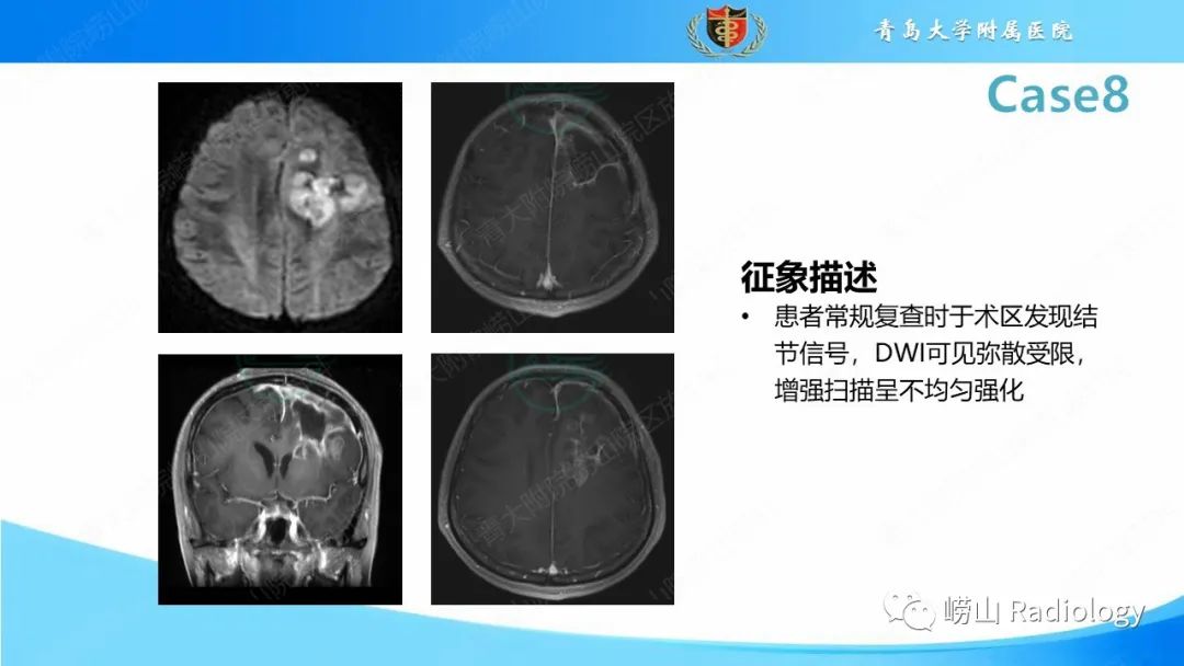 影像PPT - 【PPT】颅内肿瘤性病变-53