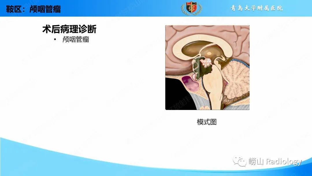 影像PPT - 【PPT】颅内肿瘤性病变-60