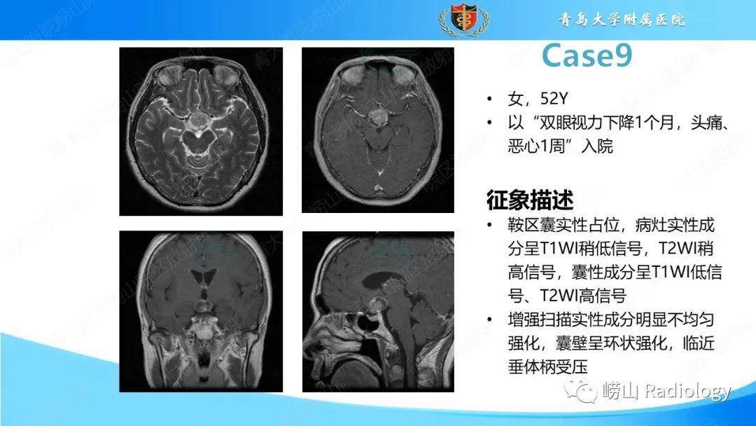 影像PPT - 【PPT】颅内肿瘤性病变-59