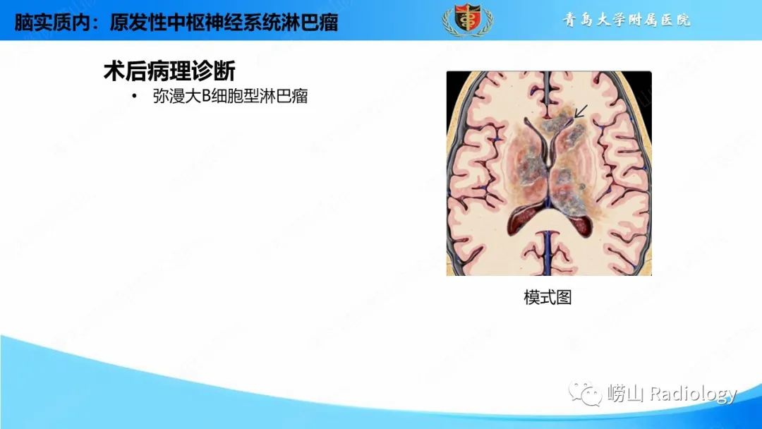 影像PPT - 【PPT】颅内肿瘤性病变-64