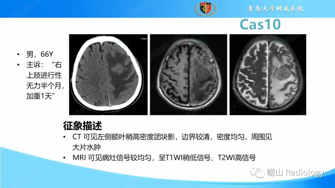 影像PPT - 【PPT】颅内肿瘤性病变-62