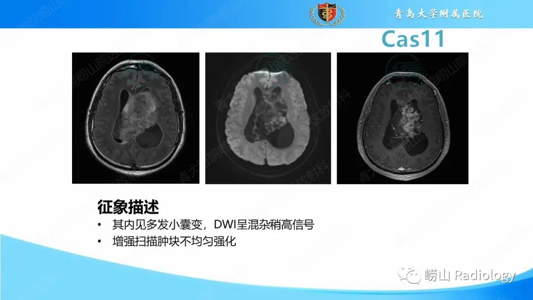 影像PPT - 【PPT】颅内肿瘤性病变-67