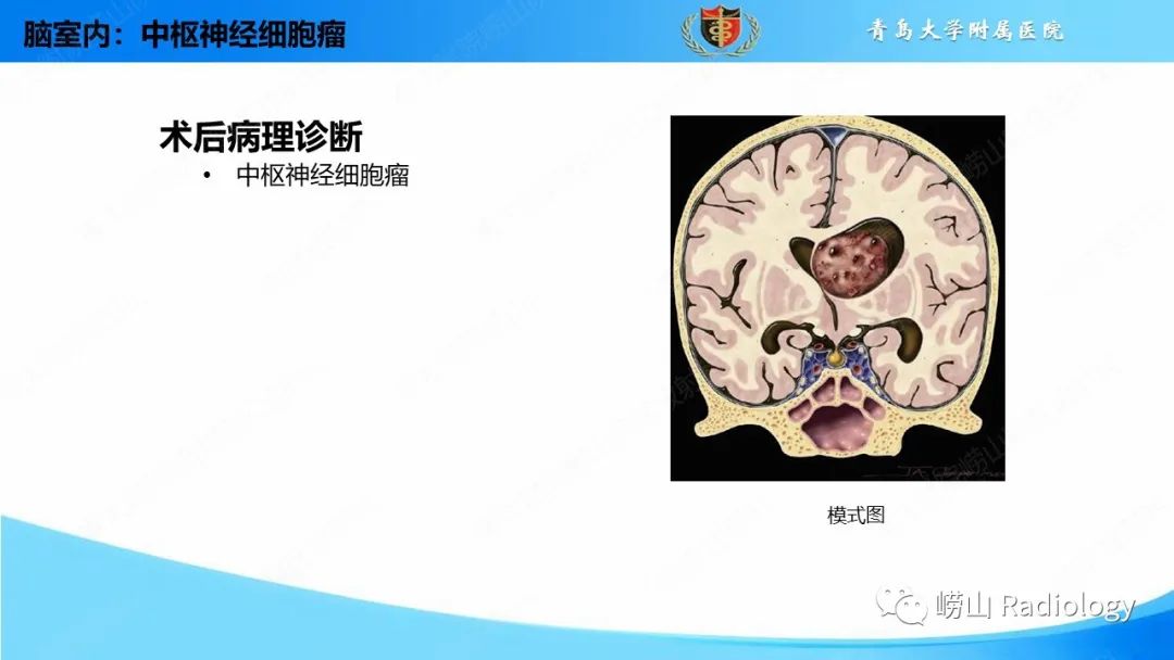 影像PPT - 【PPT】颅内肿瘤性病变-68
