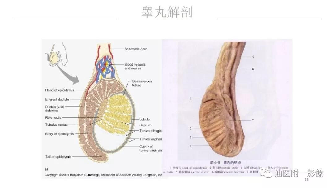 影像PPT - 【PPT】睾丸病变知多少-11