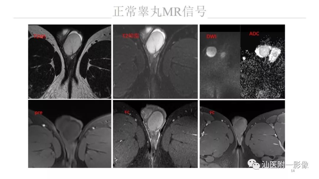 影像PPT - 【PPT】睾丸病变知多少-14