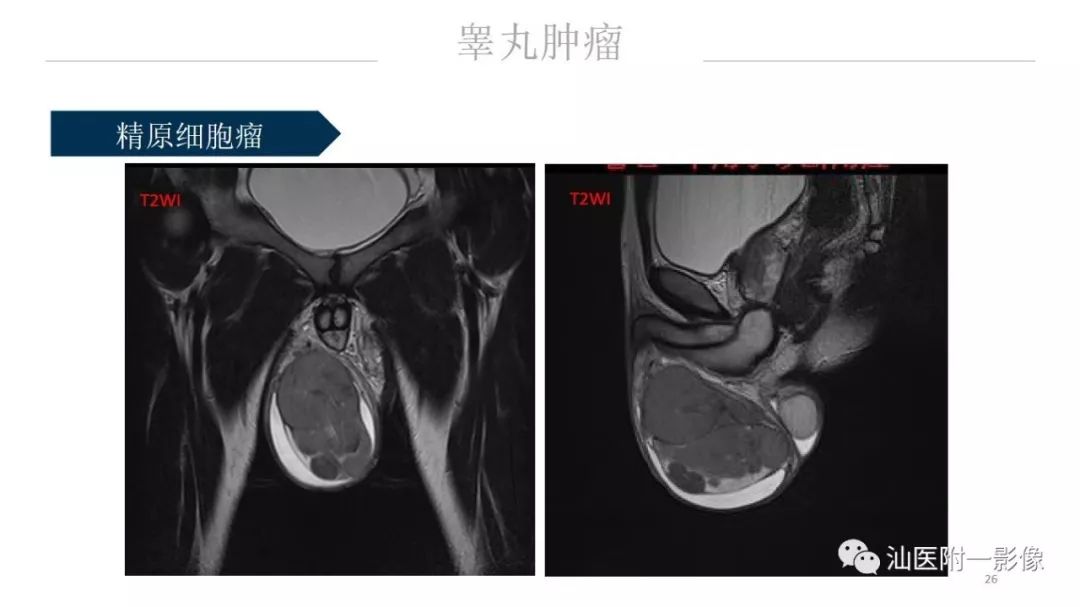 影像PPT - 【PPT】睾丸病变知多少-26