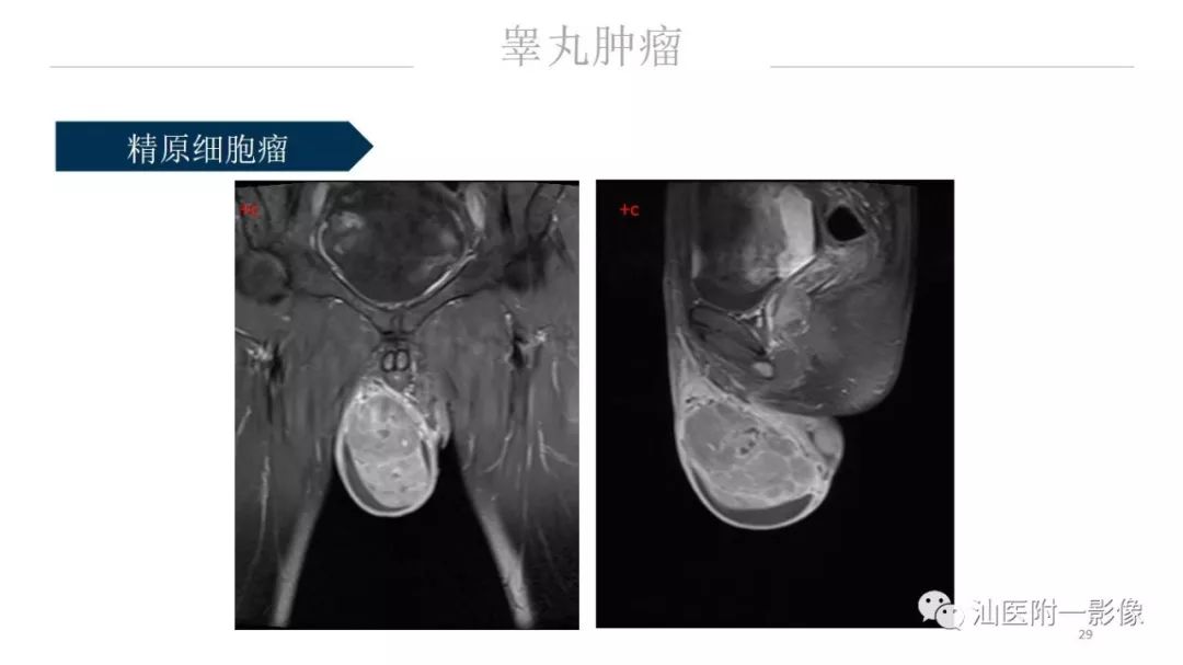 影像PPT - 【PPT】睾丸病变知多少-29