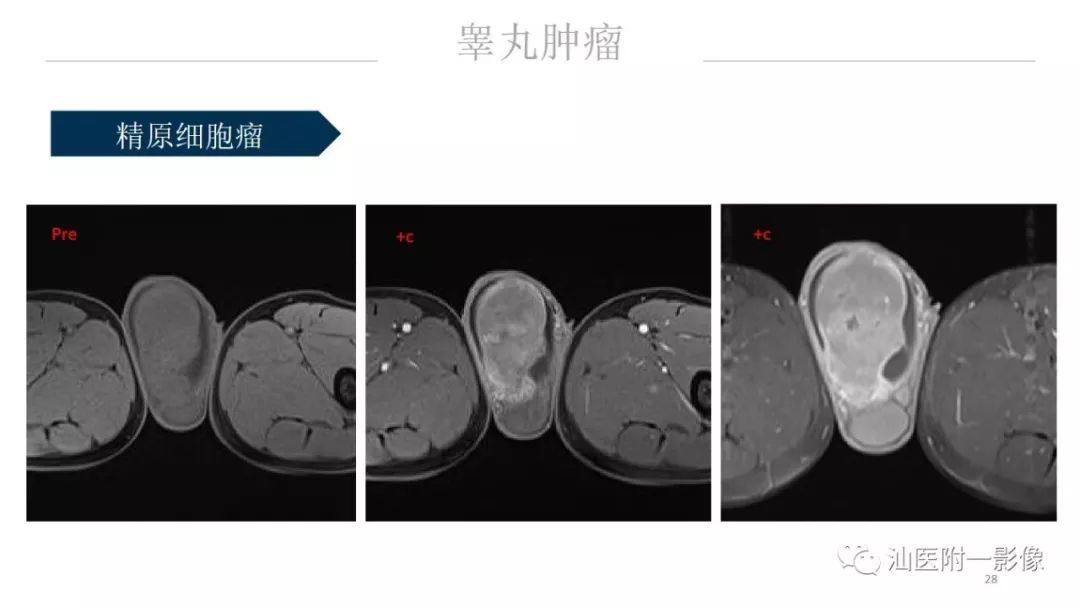 影像PPT - 【PPT】睾丸病变知多少-28