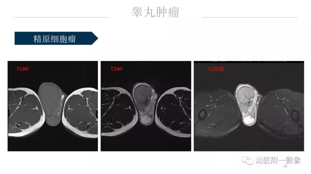 影像PPT - 【PPT】睾丸病变知多少-25