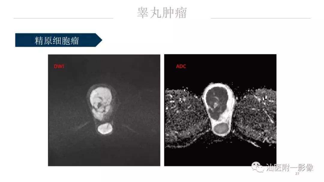 影像PPT - 【PPT】睾丸病变知多少-27