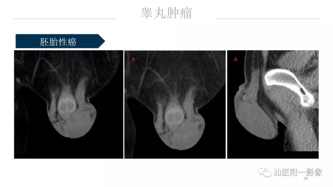 影像PPT - 【PPT】睾丸病变知多少-34