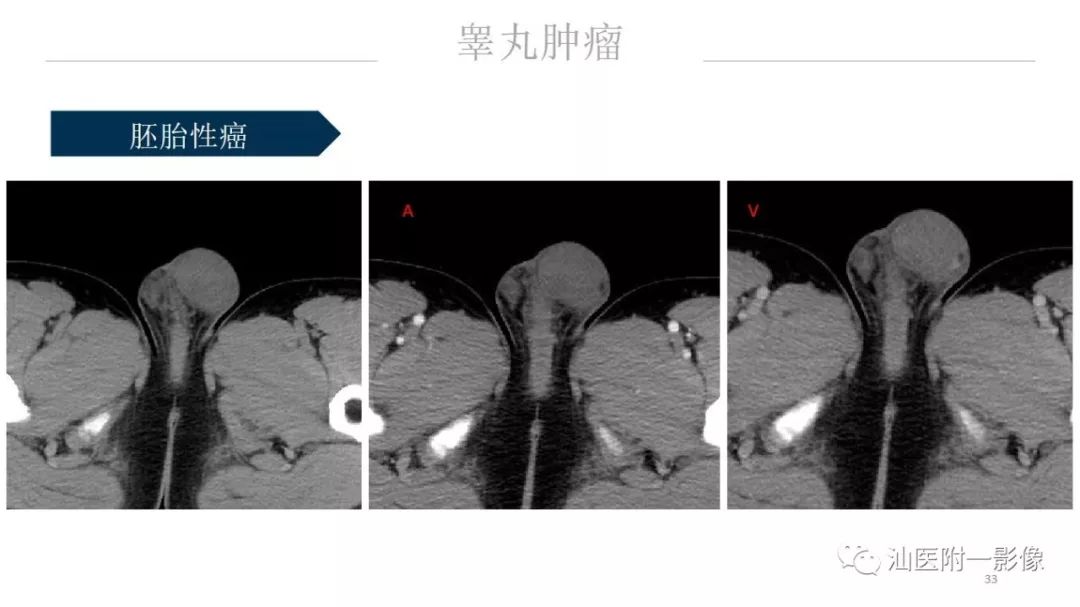 影像PPT - 【PPT】睾丸病变知多少-33