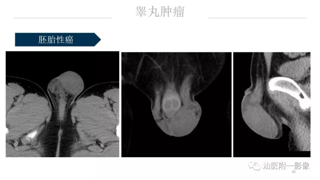 影像PPT - 【PPT】睾丸病变知多少-32