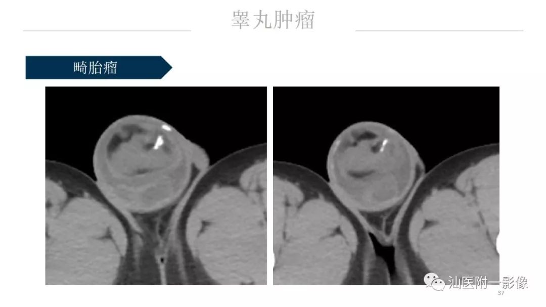 影像PPT - 【PPT】睾丸病变知多少-37