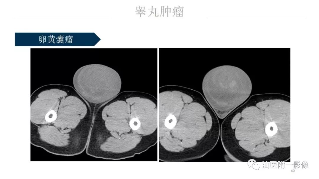 影像PPT - 【PPT】睾丸病变知多少-40