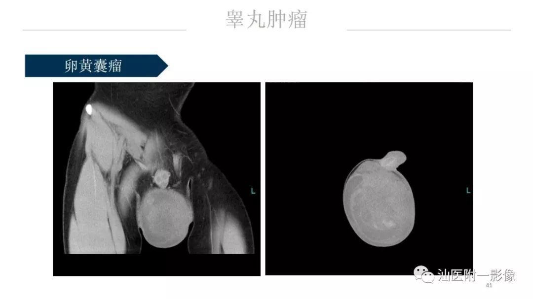 影像PPT - 【PPT】睾丸病变知多少-41