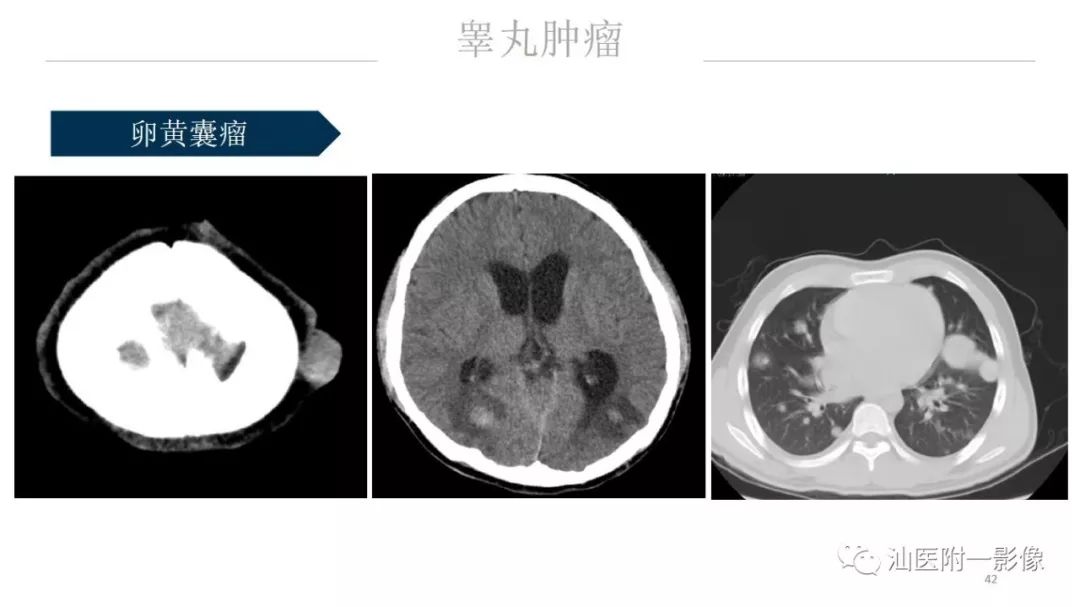 影像PPT - 【PPT】睾丸病变知多少-42