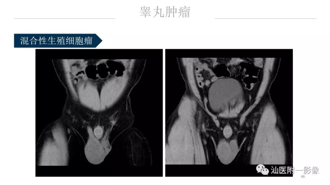 影像PPT - 【PPT】睾丸病变知多少-46