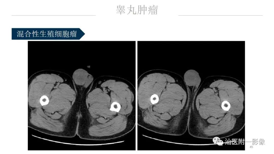 影像PPT - 【PPT】睾丸病变知多少-45