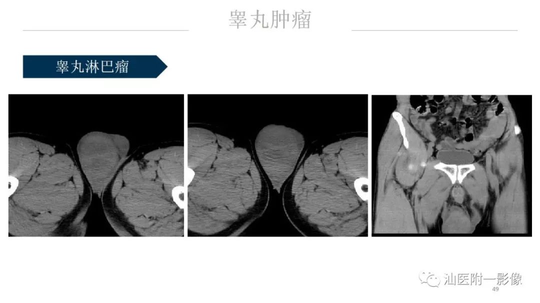 影像PPT - 【PPT】睾丸病变知多少-49