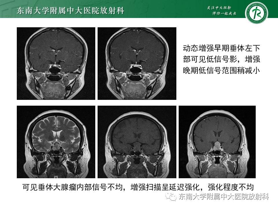 影像PPT - 【PPT】垂体腺瘤影像表现-15