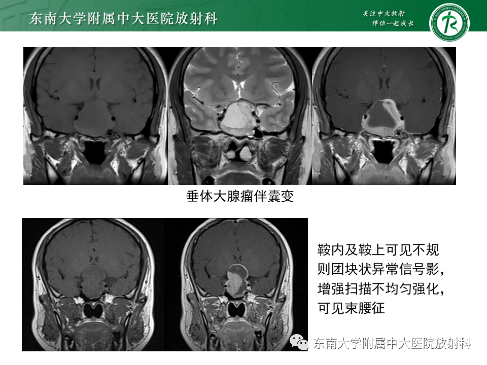 影像PPT - 【PPT】垂体腺瘤影像表现-16