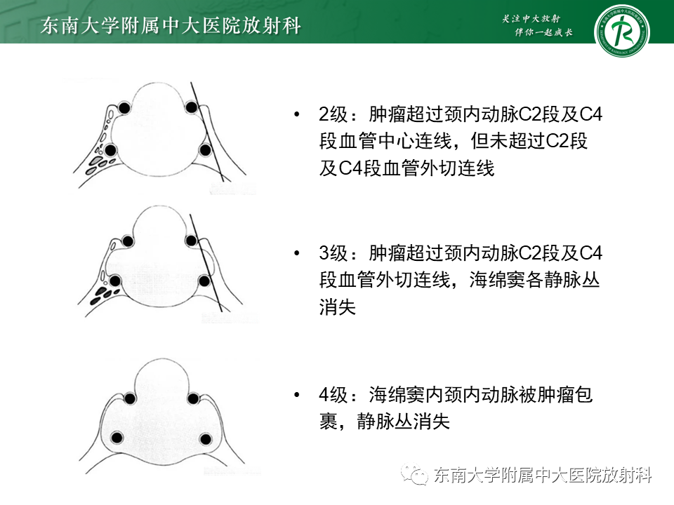 影像PPT - 【PPT】垂体腺瘤影像表现-20
