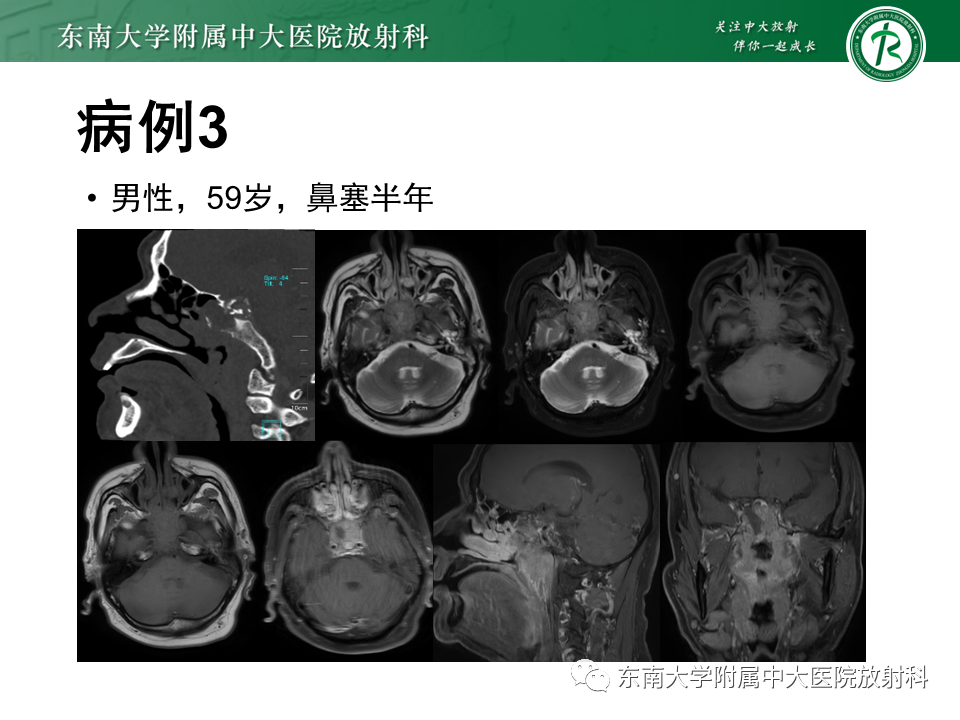 影像PPT - 【PPT】垂体腺瘤影像表现-28