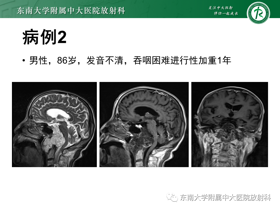 影像PPT - 【PPT】垂体腺瘤影像表现-22