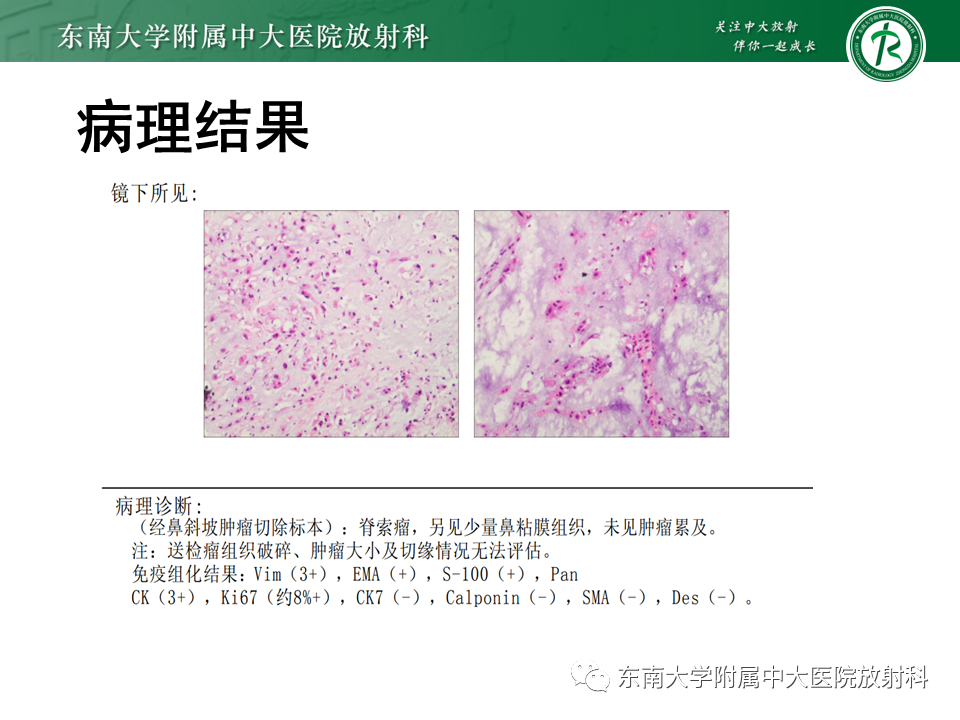 影像PPT - 【PPT】垂体腺瘤影像表现-23
