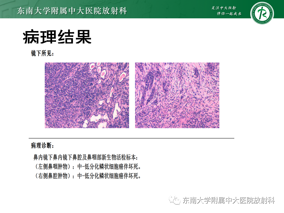 影像PPT - 【PPT】垂体腺瘤影像表现-29