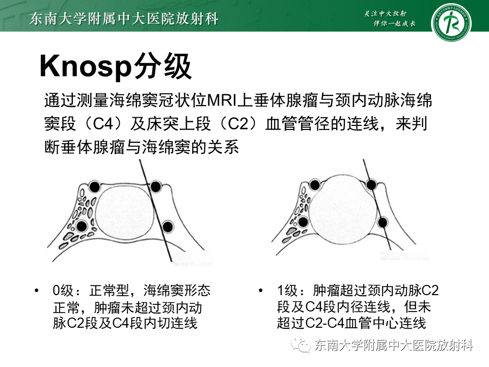 影像PPT - 【PPT】垂体腺瘤影像表现-19