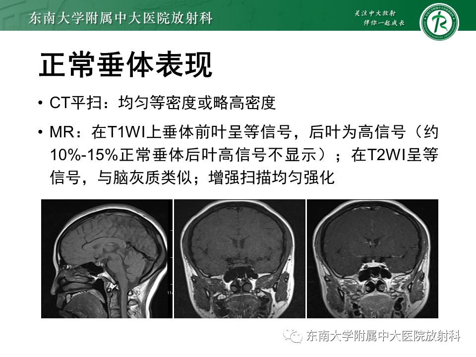 影像PPT - 【PPT】垂体腺瘤影像表现-7
