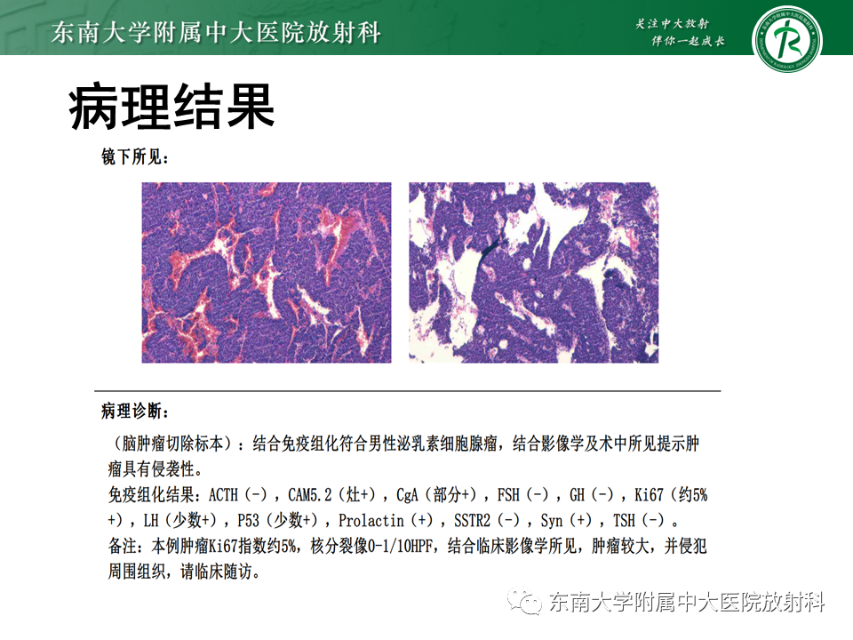 影像PPT - 【PPT】垂体腺瘤影像表现-2