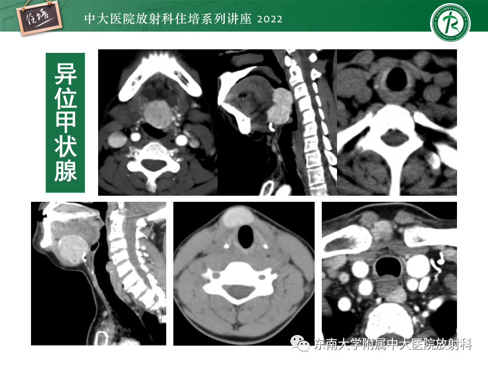 影像PPT - 【PPT】甲状腺肿瘤及肿瘤样病变影像诊断与评估-20