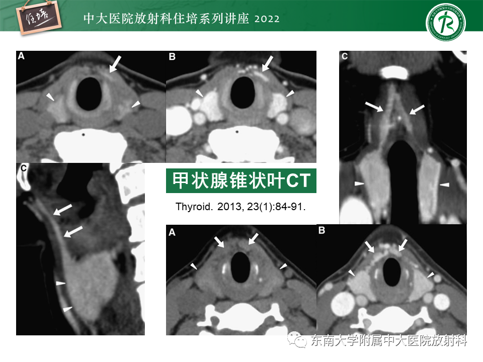 影像PPT - 【PPT】甲状腺肿瘤及肿瘤样病变影像诊断与评估-17