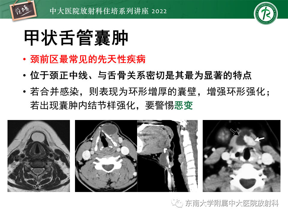 影像PPT - 【PPT】甲状腺肿瘤及肿瘤样病变影像诊断与评估-21