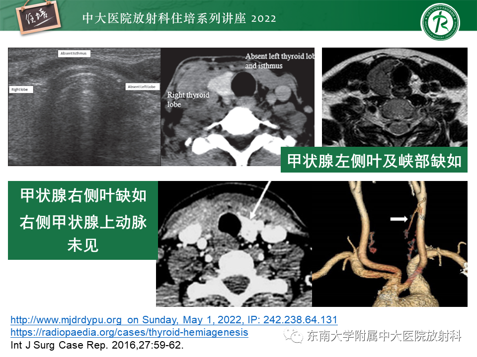 影像PPT - 【PPT】甲状腺肿瘤及肿瘤样病变影像诊断与评估-23